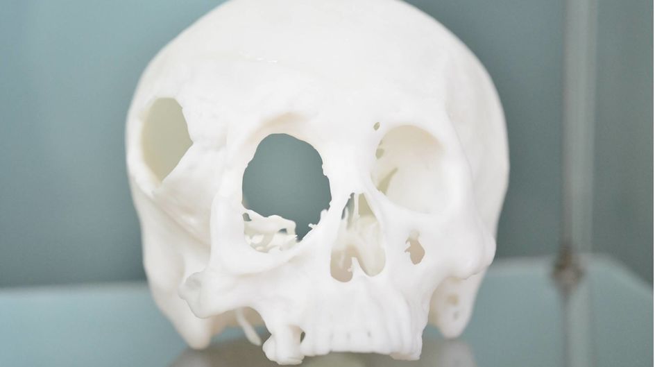 Meditool’s 3D-printed PEEK implants for the orthopaedics implant market